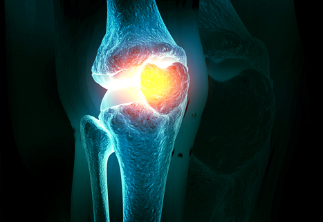 Stammzellentherapie bei Kniearthrose